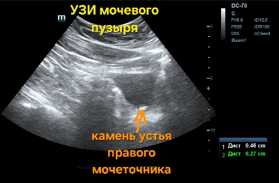 УЗИ мочевого пузыря